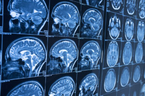 How Findlay Personal Injury Lawyers Can Help With Your Brain Injury Case in Hamilton