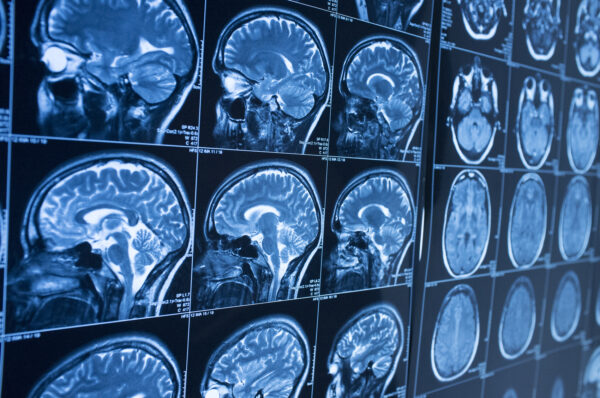 What Is the Occipital Lobe & What Does It Do?